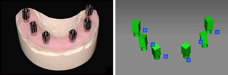 iCamBody referans parçaları ve fotogrametriyle hesaplanmış üç boyutlu implant konumları