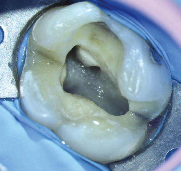 Dental mikroskop altında görülen dişin pulpa odası ve kanal girişleri