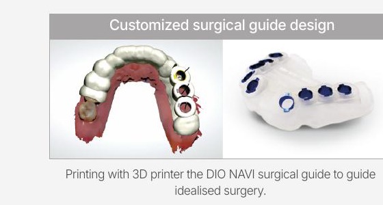 DIO NAVI patient-specific implant surgical guide and digital design
