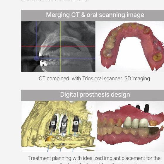 DIO NAVI planning that combines CBCT and an intraoral scan before implant surgery