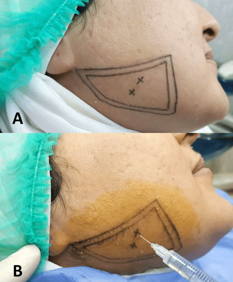 Masseter kasında botulinum toksin uygulama alanının belirlenmesi
